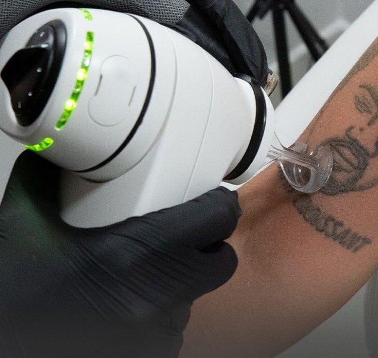 У Лондоні можна безплатно видалити татуювання з Каньє Вестом