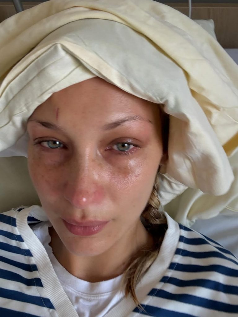 Белла Хадід потрапила до лікарні через загострення хвороби Лайма